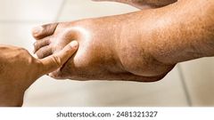 Feet swelling in older women [shuttershock]