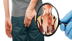 haemorrhoids